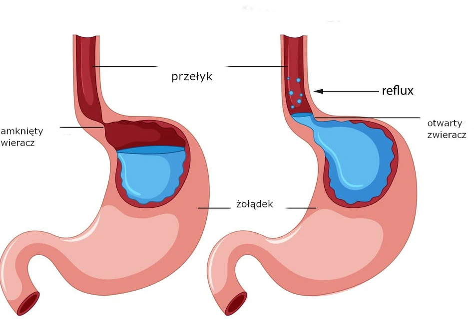 Na czym polega refluks?